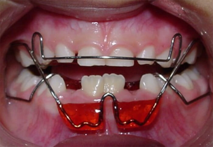Figura 12c Posicionador Mandibular Quirós Crespo (Fuente:propia)