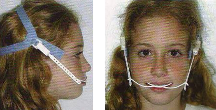 Figura 13 Face Bow - Tracción Alta (Fuente: Ortodoncia en Dentición Mixta) (21)