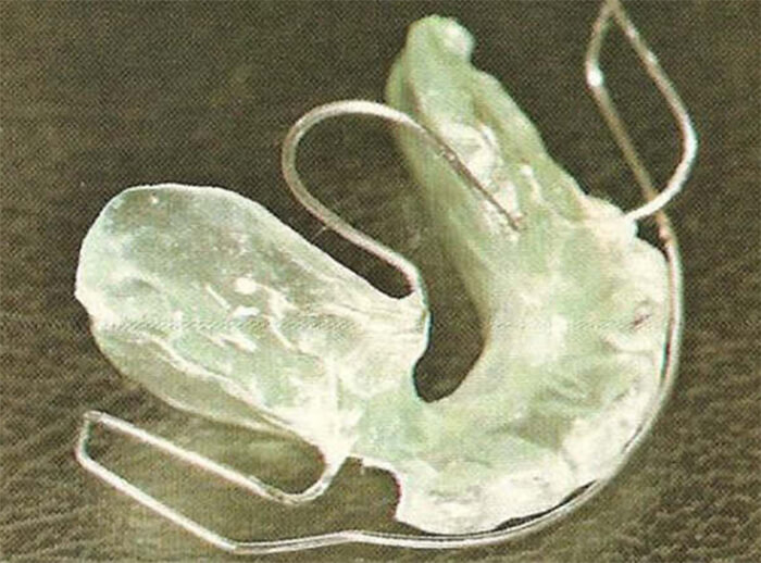 Figura 14a Bionator (Fuente: Bases Biomecánicas y Aplicaciones Clínicas en Ortodoncia Interceptiva) (19)