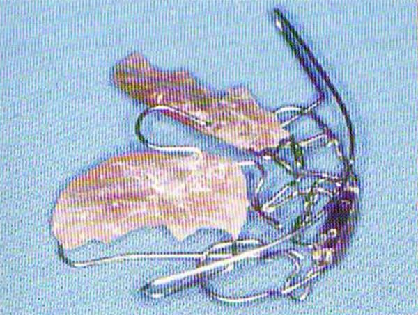 Figura 14b Bimler (Fuente: Bases Biomecánicas y Aplicaciones Clínicas en Ortodoncia Interceptiva) (19)