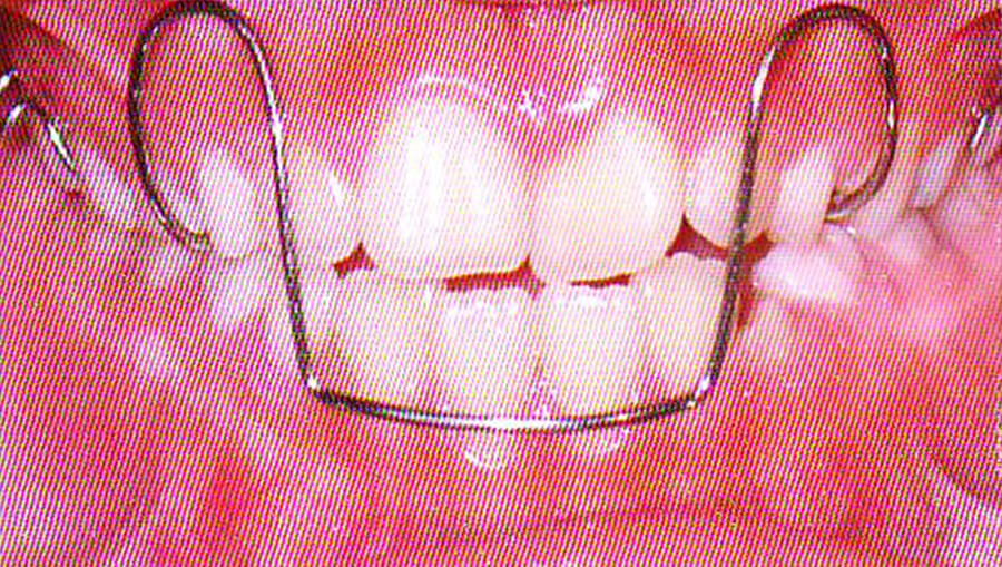 Figura 15c Arco de Eschler (Fuente: Ortodoncia en Dentición Mixta) (21)