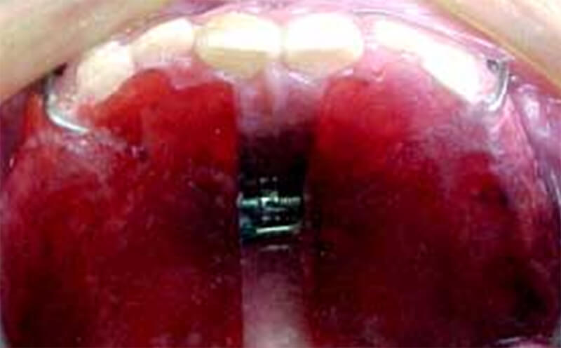 Figura 16a Expansor Rápido de Haas Modificado con Ganchos de Protracción (Fuente: Revista Latinoamericana de Ortodoncia y Odontopediatría) (29)
