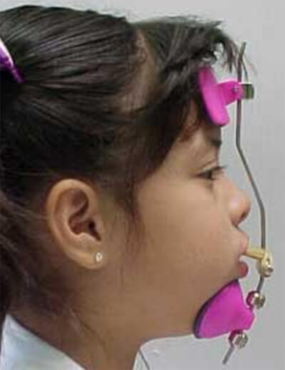 Figura 16b Máscara de Protracción tipo Petit (Fuente: Revista Latinoamericana de Ortodoncia y Odontopediatría) (29)