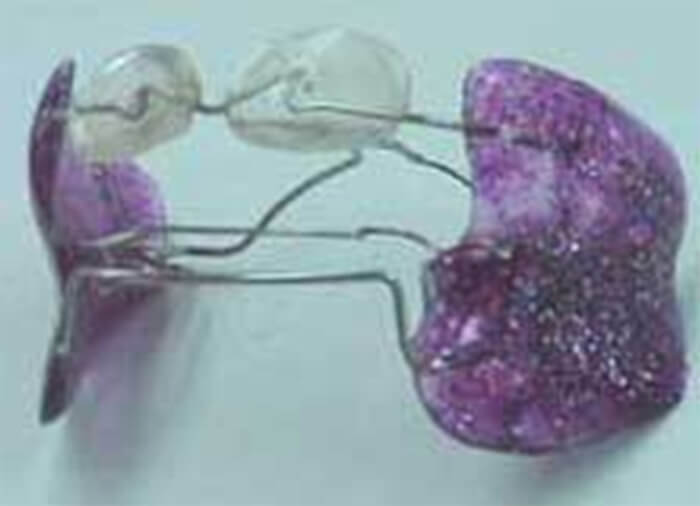Figura 17. Frankel III (Fuente: Revista Latinoamericana de Ortodoncia y Odontopediatría)
