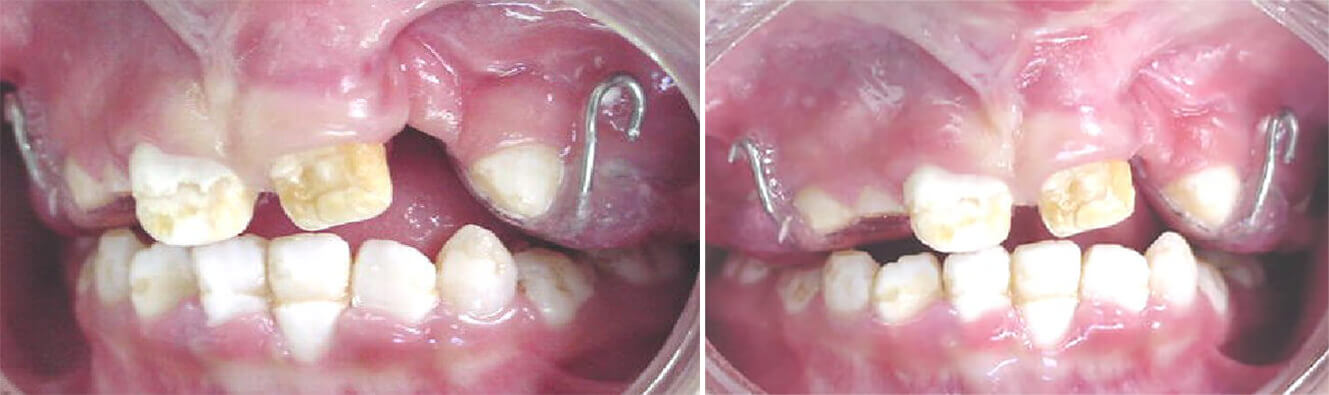 Fig. 10 / Fig. 11 Disminución de la fisura de 11 mm al inicio del tratamiento quedando 5 mm al final.