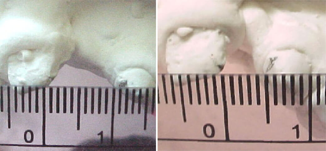 Fig. 12 / Fig. 13 Disminución de la fisura de 11 mm al inicio del tratamiento quedando 5 mm al final.