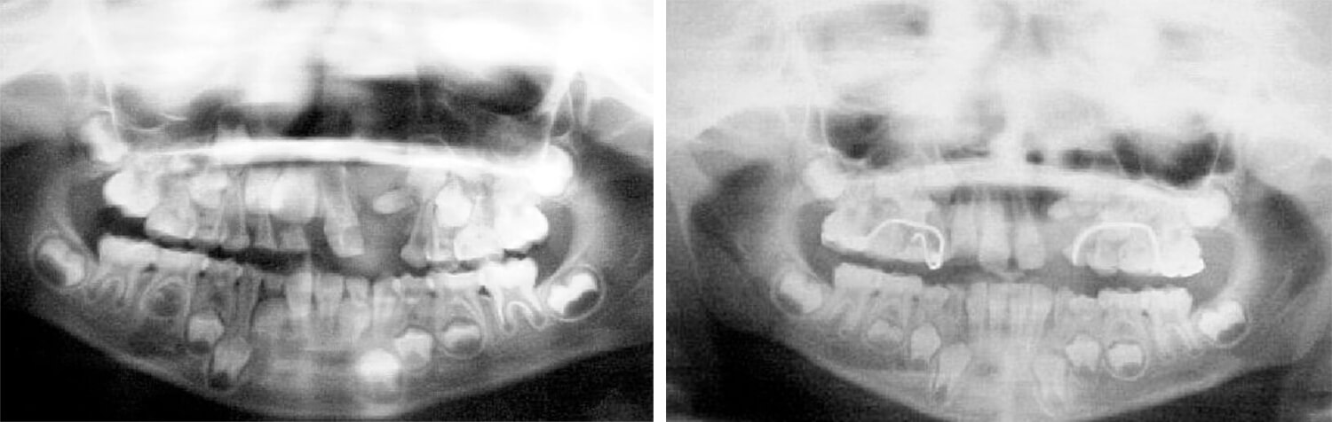Fig. 18 / Fig. 19 Valoración radiográfica de inicio y final del cierre de la fisura.