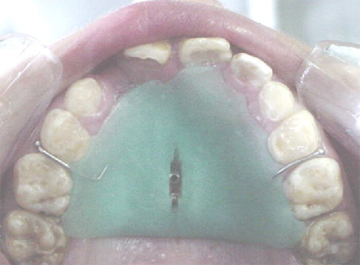 Fig. 20 Retención final.