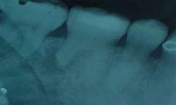 Fig. 1 Zona radiolúcida en la raíz distal con reabsorción radicular. www.lookfordiagnosis.com