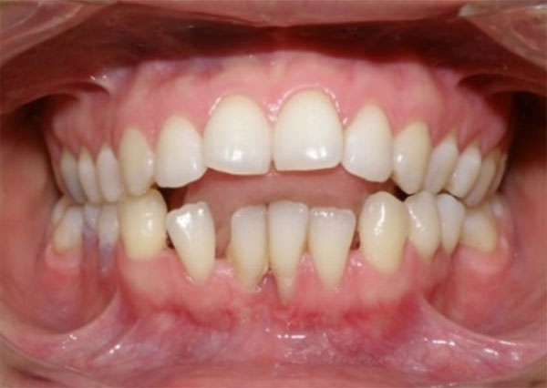 Fig.3 Paciente con hábito de interposición lingual. www.clidentperu.com