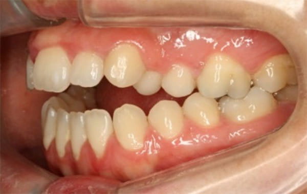 Fig.4 Paciente con mordida abierta. www.ortodonciafutura.com