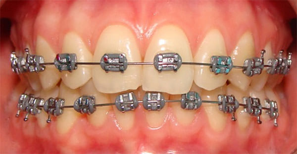 Fig.5 Aparatología fija vestibular, brackets metálicos. www.ortodonciaecuador.com