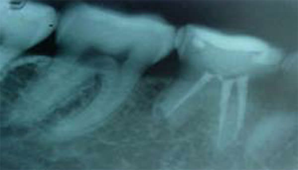 Fig.7 Radiografía de control después de un año y nueve meses de terminado el tratamiento www.lookfordiagnosis.com
