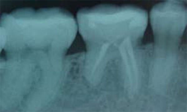 Fig.8 Radiografía de control a los dos años y ocho meses de terminado el tratamiento www.lookfordiagnosis.com