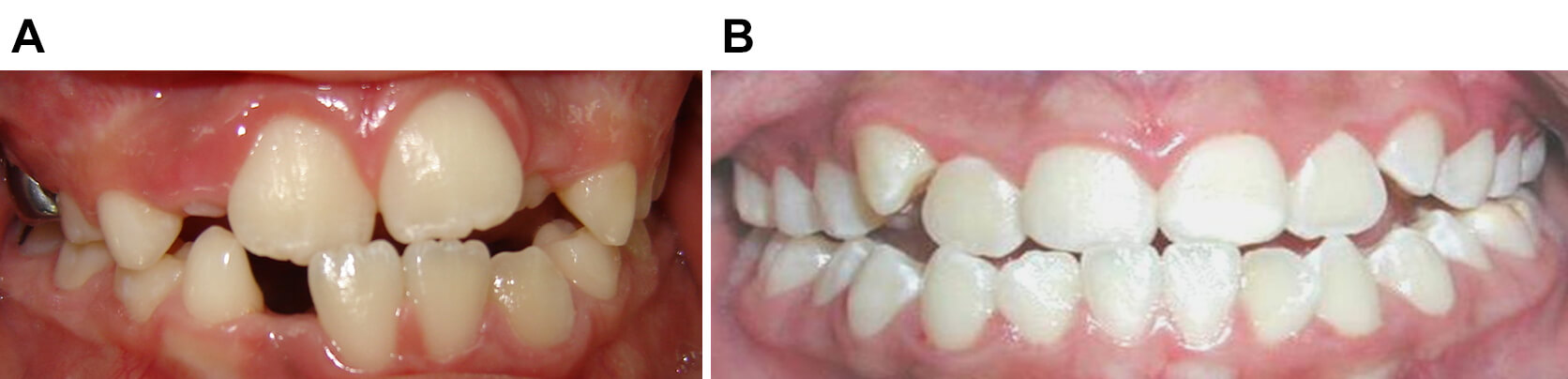 FIGURA 1 Clasificación de mordida cruzada dental anterior