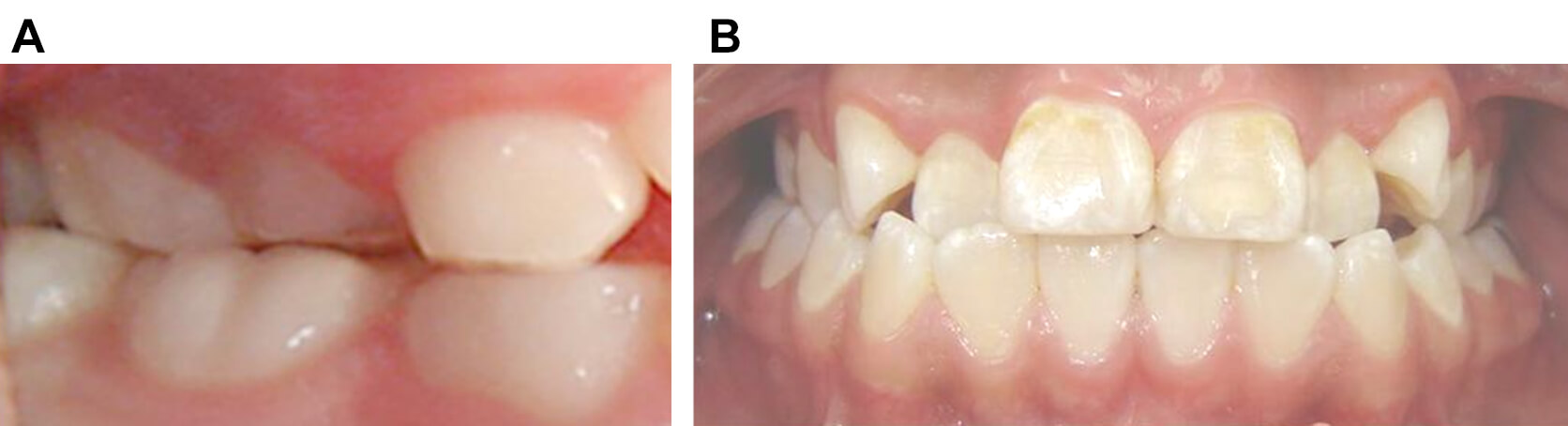 FIGURA 2 Clasificación de mordida cruzada dental posterior