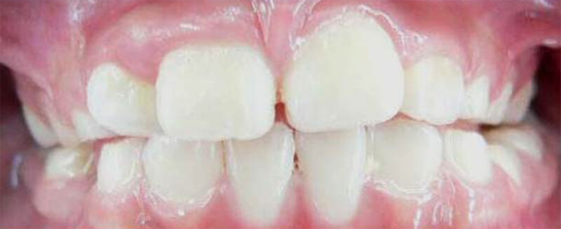 FIGURA 3 Mordida cruzada dental mixta