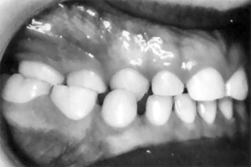 Figura 2 Mordida cruzada posterior del lado derecho del arco dentario