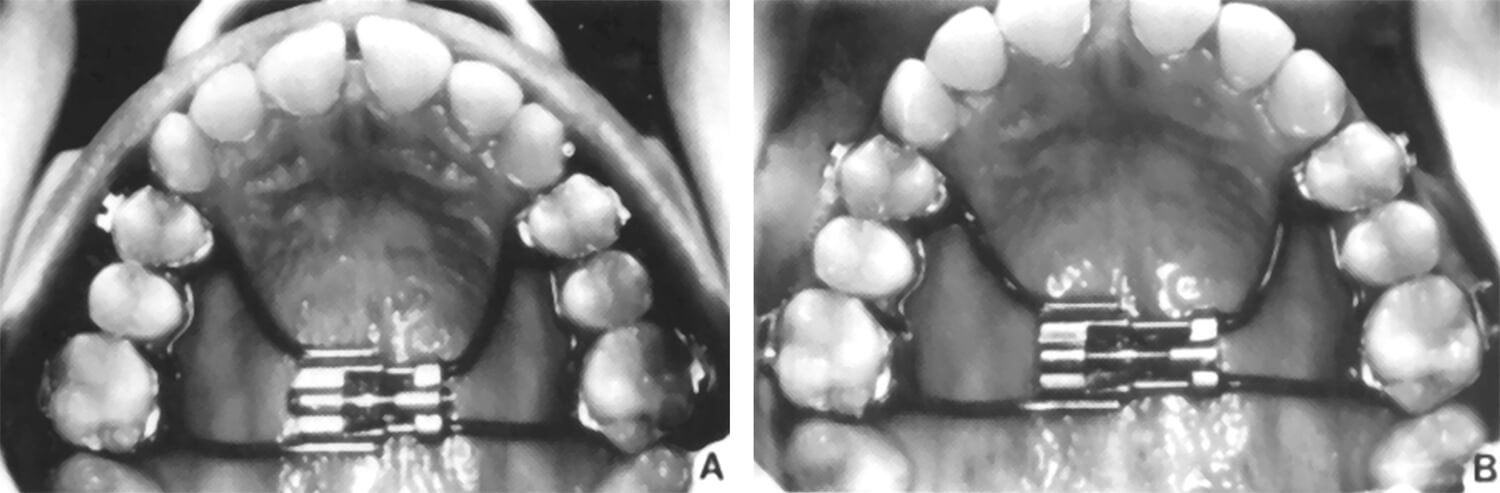 Figura 3 Respuesta típica del maxilar después de una activación diaria con un expansor tipo Hyrax, A) Después de 14 días de activación. B) Después de 28 días de activación. Observe el desarrollo del diastema en la línea media.