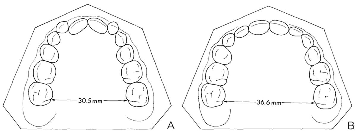 Figura 5 Cambios dimensionales típicos de] arco maxilar después de la expansión rápida. A) Antes del tratamiento. B) Inmediatamente después de la remoción de la férula acrílica de expansión.