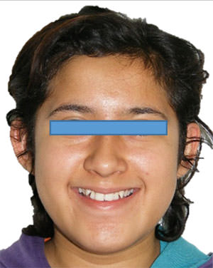 Fig. 3 De frente de sonrisa en inicio