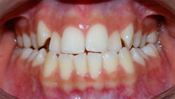 Fig. 4 Intraoral de frente