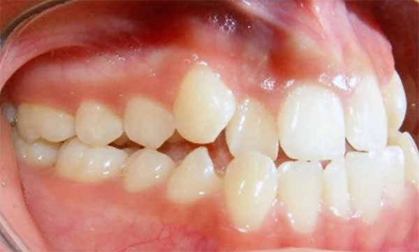 Fig. 5 Intraoral lateral derecha