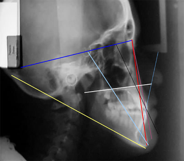 Fig. 9 Radiografía lateral de cráneo con trazos cefalometricos