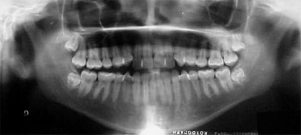 Fig. 10 Radiografía panorámica