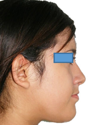 Fig. 12 Sonrisa progreso
