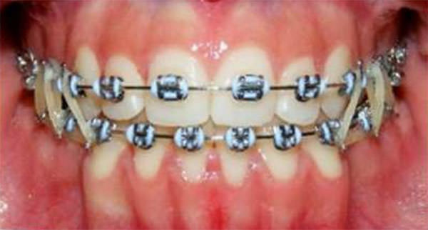 Fig. 13 Intraoral de frente progreso
