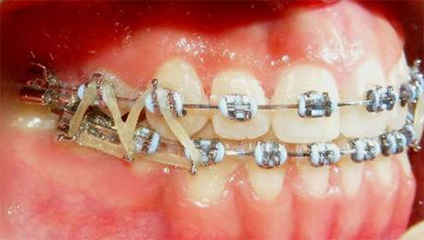 Fig. 14 Lateral derecha clase 1 canina