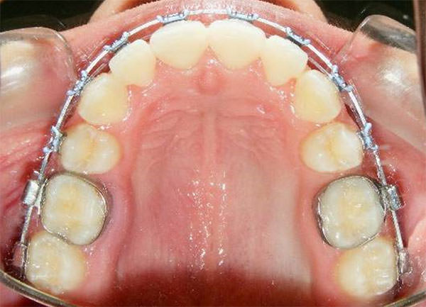 Fig. 16 Oclusal superior progreso
