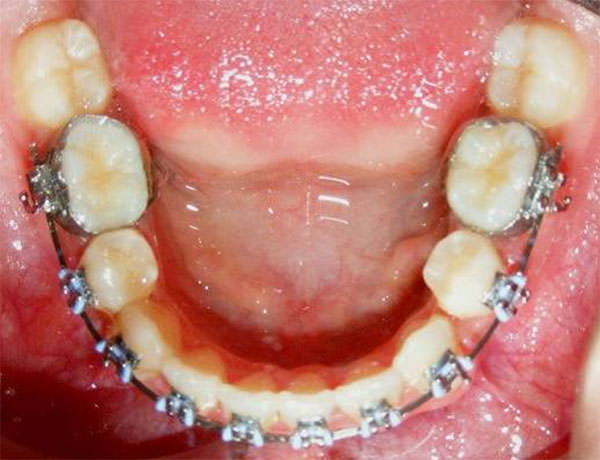 Fig. 17 Oclusal inferior progreso.