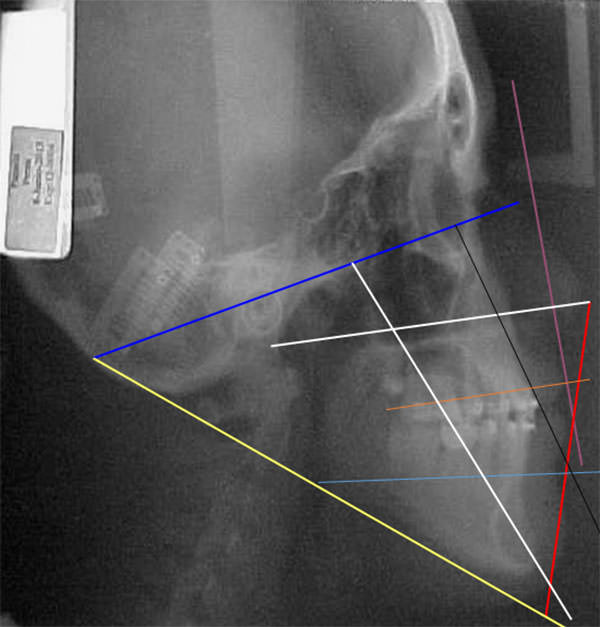 Fig. 18 Rx lateral de cráneo progreso con trazos cefalometricos