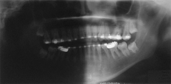 Fig. 19 Radiografía panorámica de progreso