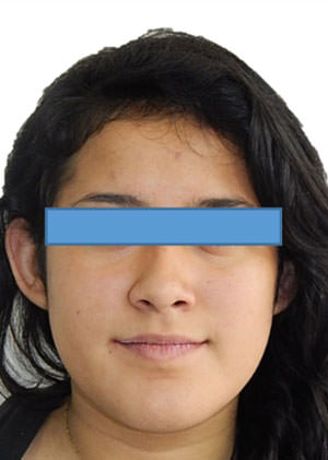 Fig. 20 De frente final