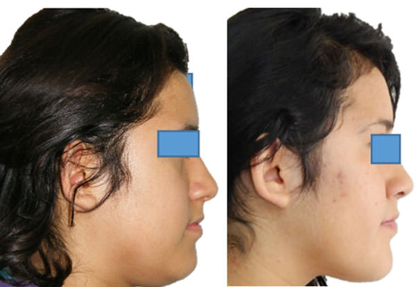 Fig. 21 Comparación de perfil inicio y final
