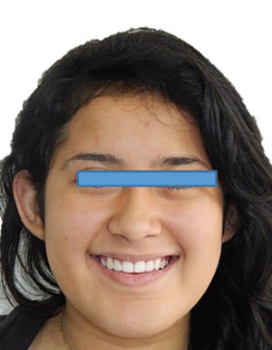 Fig. 22 Sonrisa final