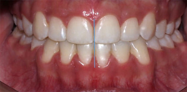 Fig. 23 Intraoral de frente final
