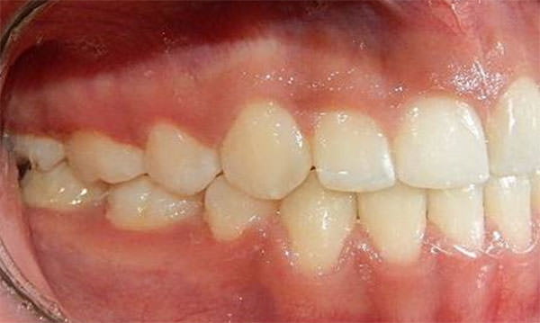 Fig. 24 Lateral derecha final