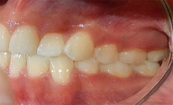 Fig. 25 Lateral izquierda final