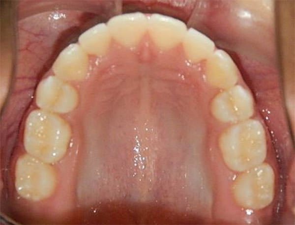 Fig. 26 Oclusal superior final