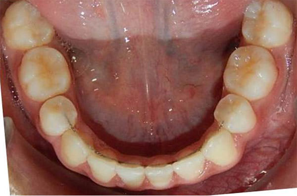 Fig. 27 Oclusal inferior final