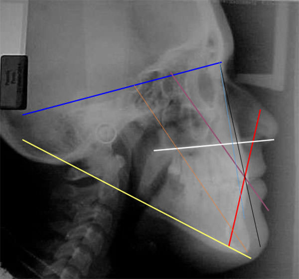 Fig. 28 Radiografía lateral de cráneo final con trazados cefalometricos