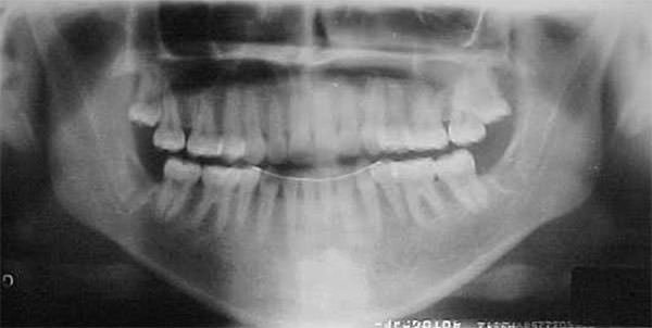 Fig. 29 Radiografía panorámica final