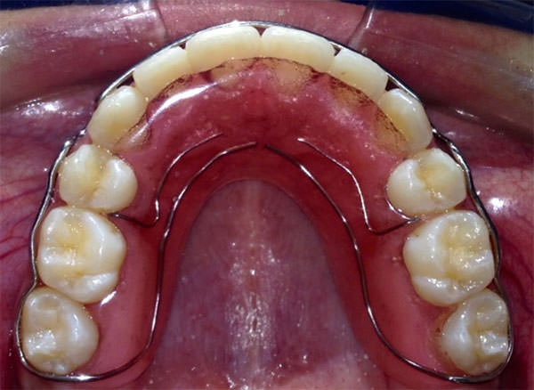Fig.30 Retenedor circunferencial superior