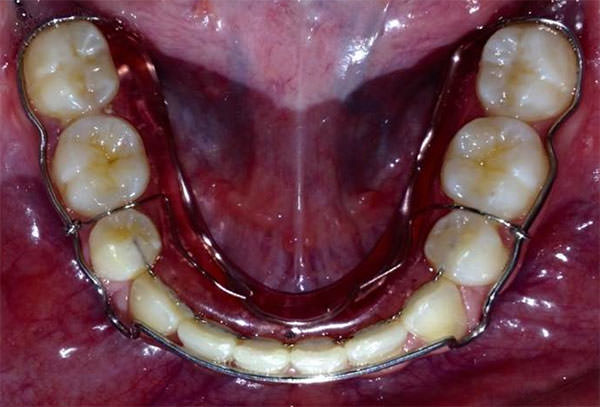Fig. 31 Retenedor circunferencial inferior.
