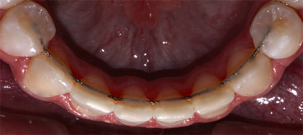 Fig. 32 Retenedor fijo del diente 34 al 44 inferior.