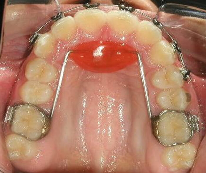 Figura 3 Muestra Botón de Nace. Fuente propia